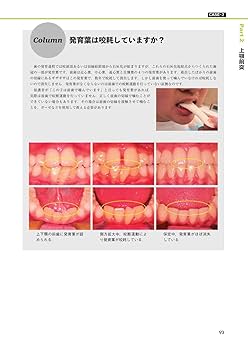 臨床医のための床矯正・矯正治療 反対咬合篇 臨床家のための床矯正治療 不正咬合別のアプローチ1: 叢生・上顎